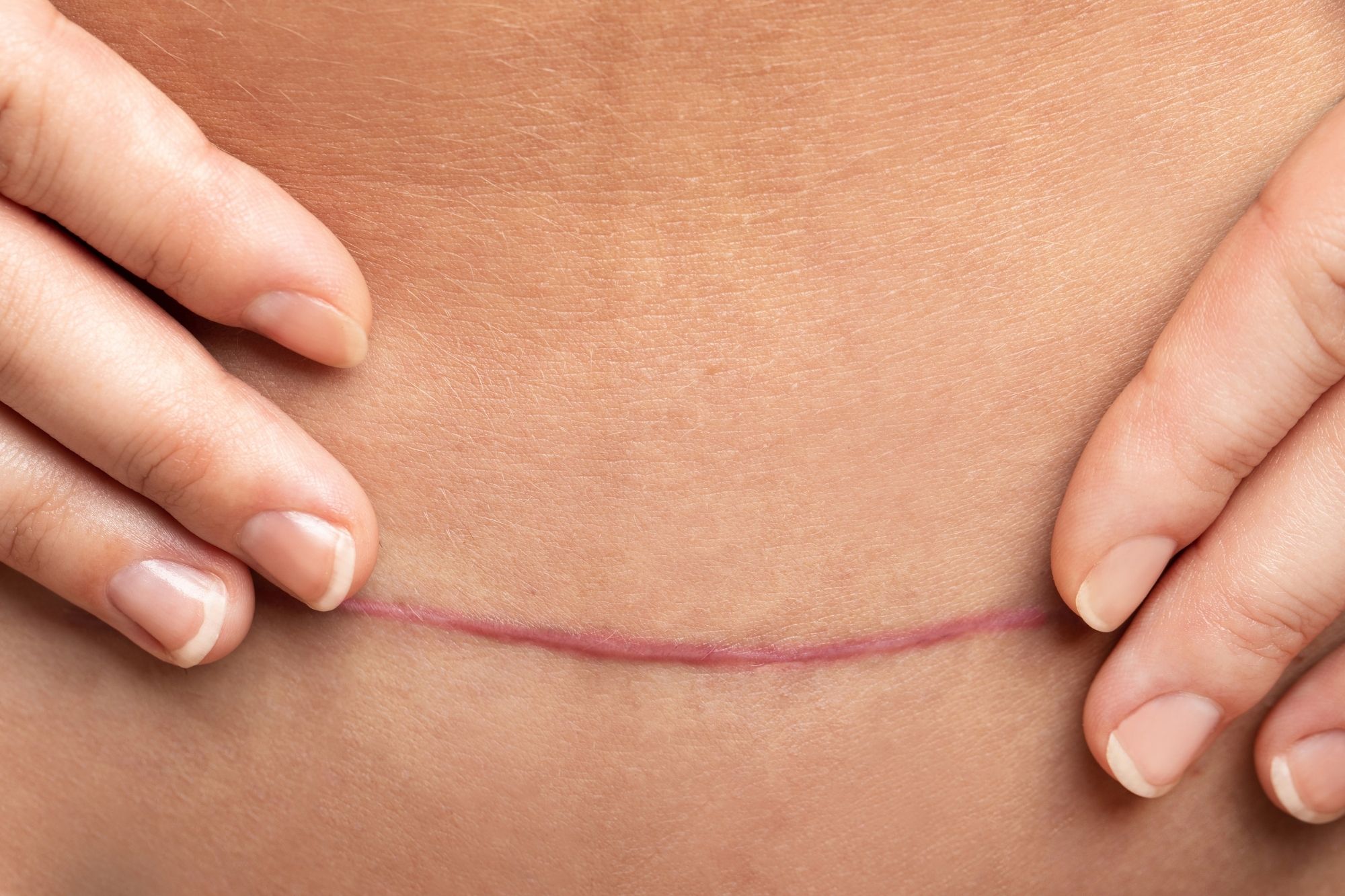 Tummy Tuck Scar