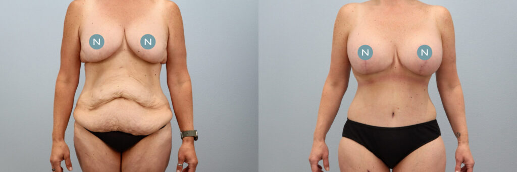 Mommy makeover before and after