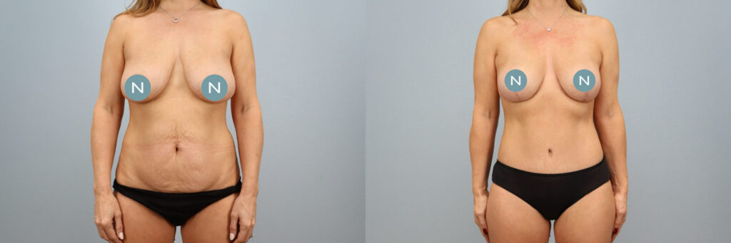 Mommy makeover before and after