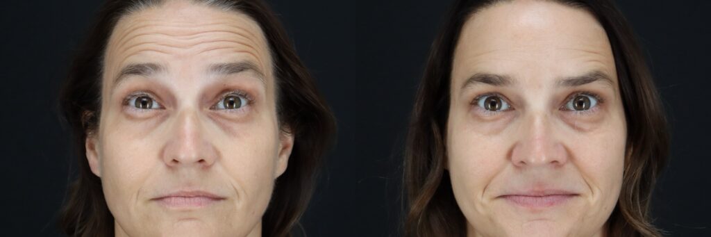 Before and after results of woman with botox