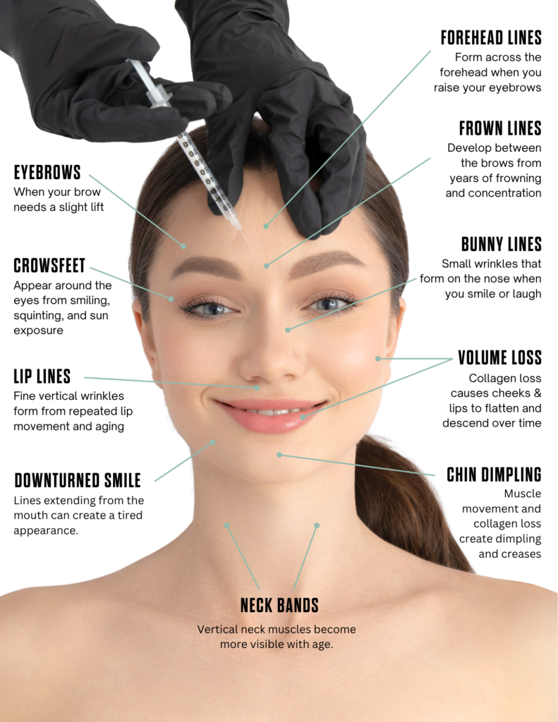 Areas that Botox and Dysport can treat