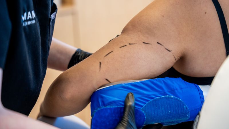 coolsculpting cost arm