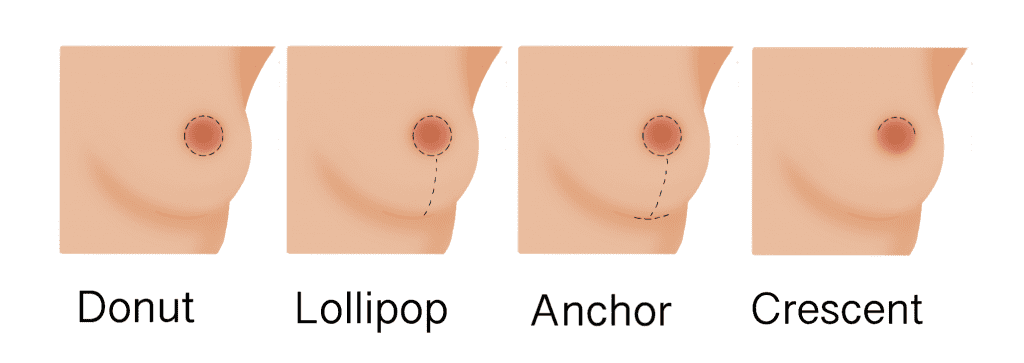Graphic of diffent types of best lift incisions