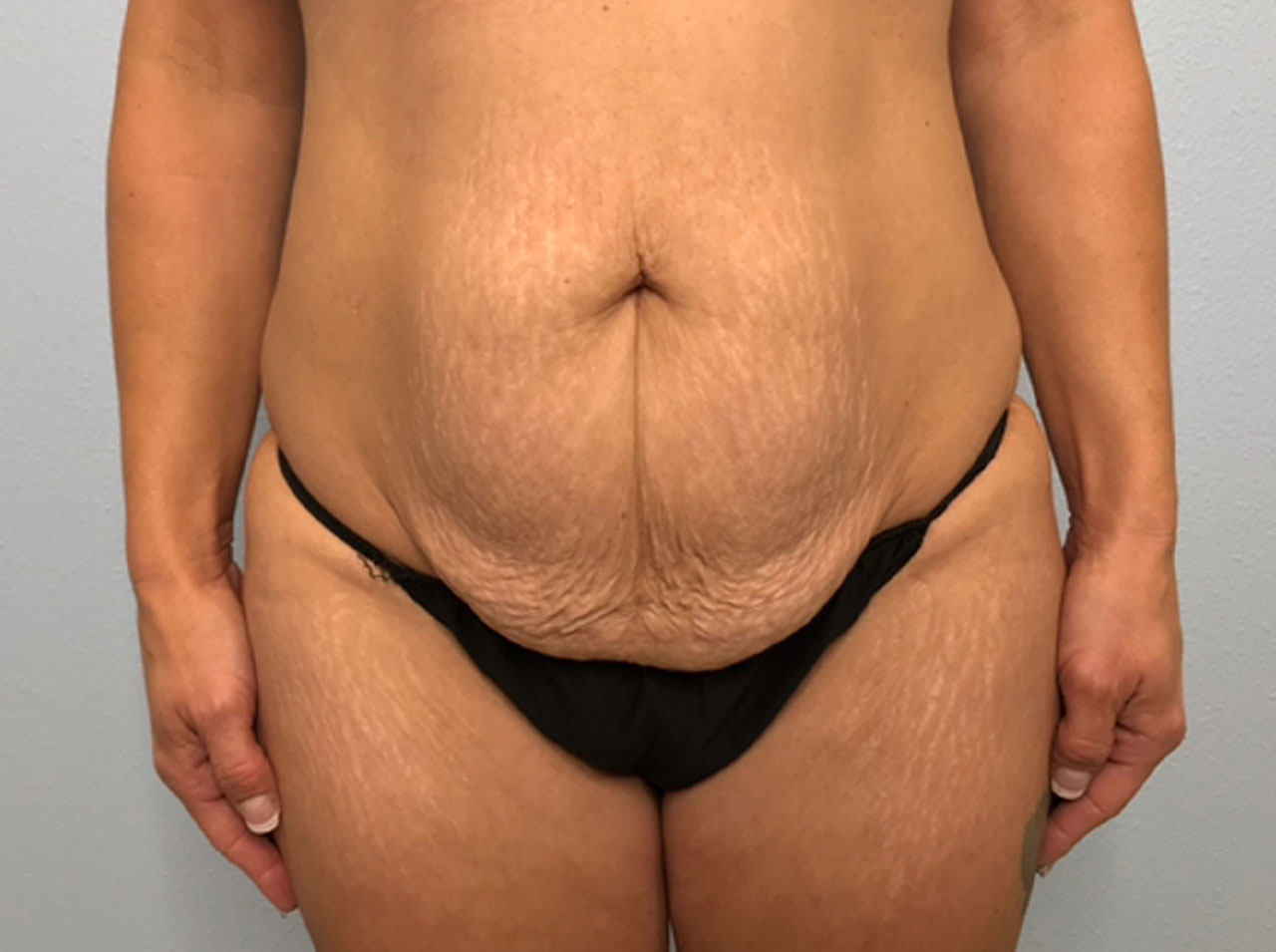Tummy Tuck Revision Surgery Before & After Photo Gallery - Patient #1