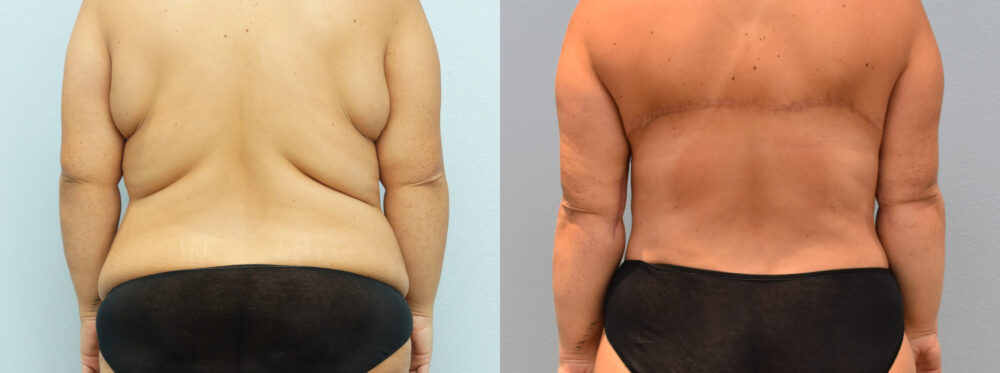 Before and After Awake Tickle of mid Back/ bra-line fat and love