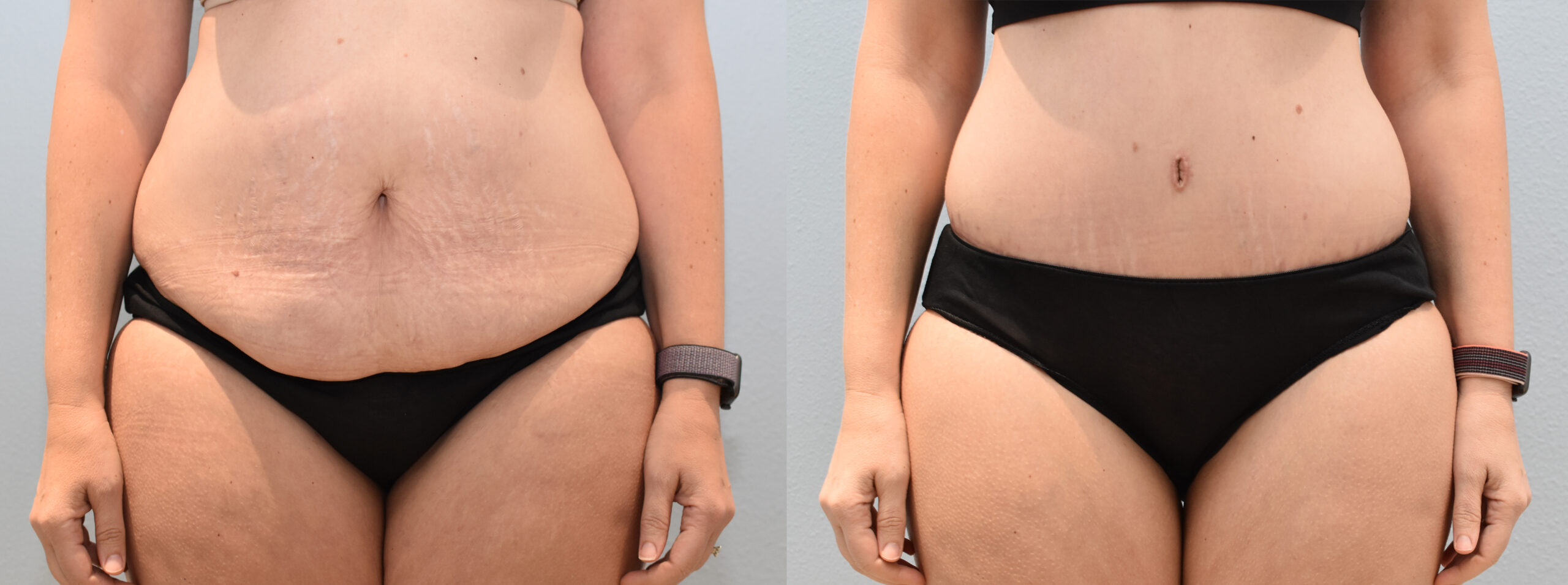 Tummy Tuck Before & After Photos  Neaman Plastic Surgery & Medi Spa