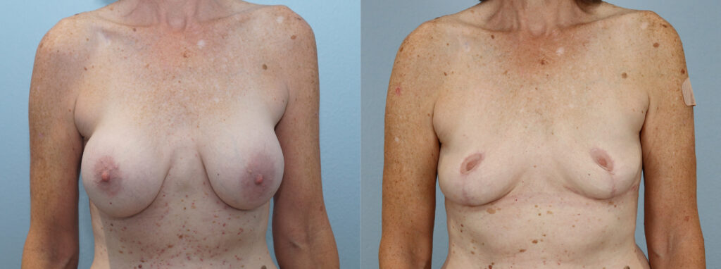 Breast Implant Removal
