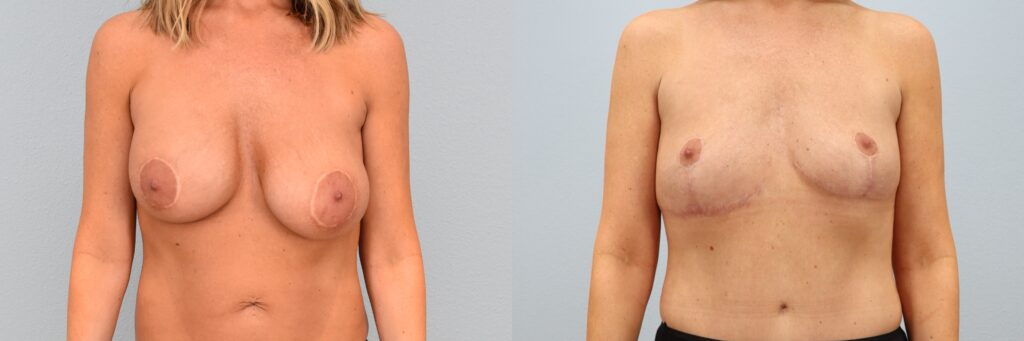 Breast Implant Removal