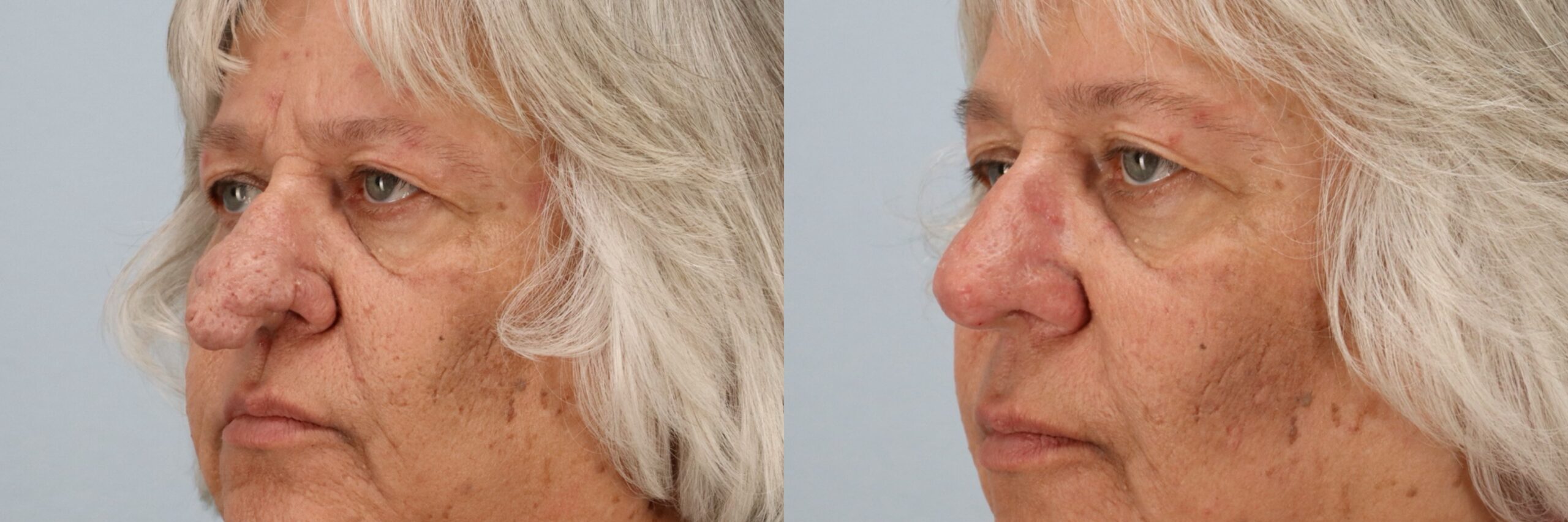 Before and after – Laser Resurfacing – Female patient, age 60+ – Image 5