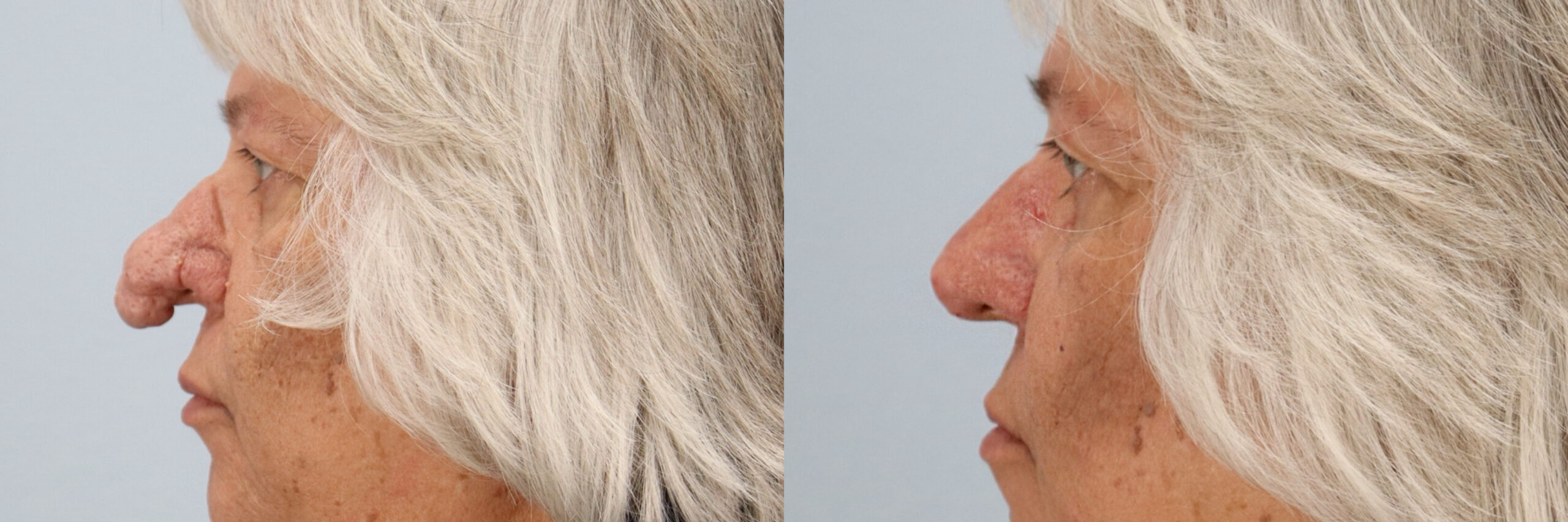 Before and after – Laser Resurfacing – Female patient, age 60+ – Image 6