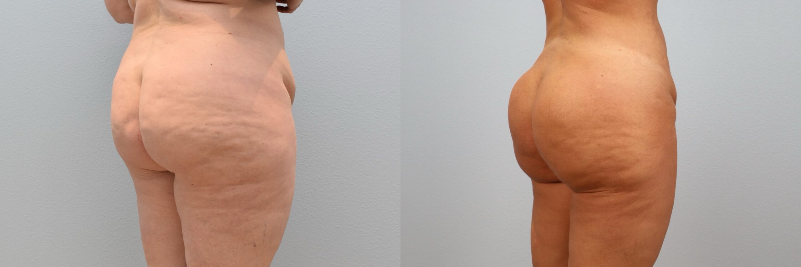 KD Lipo, BBL Back Left