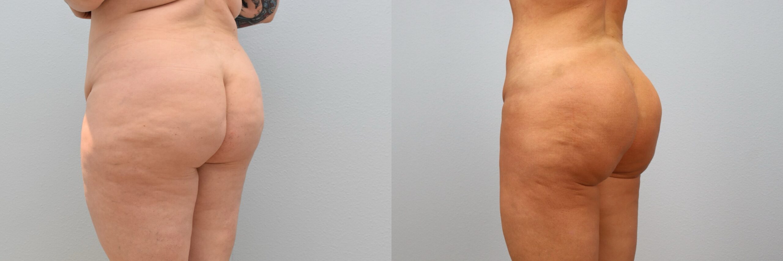 KD Lipo, BBL Back Right