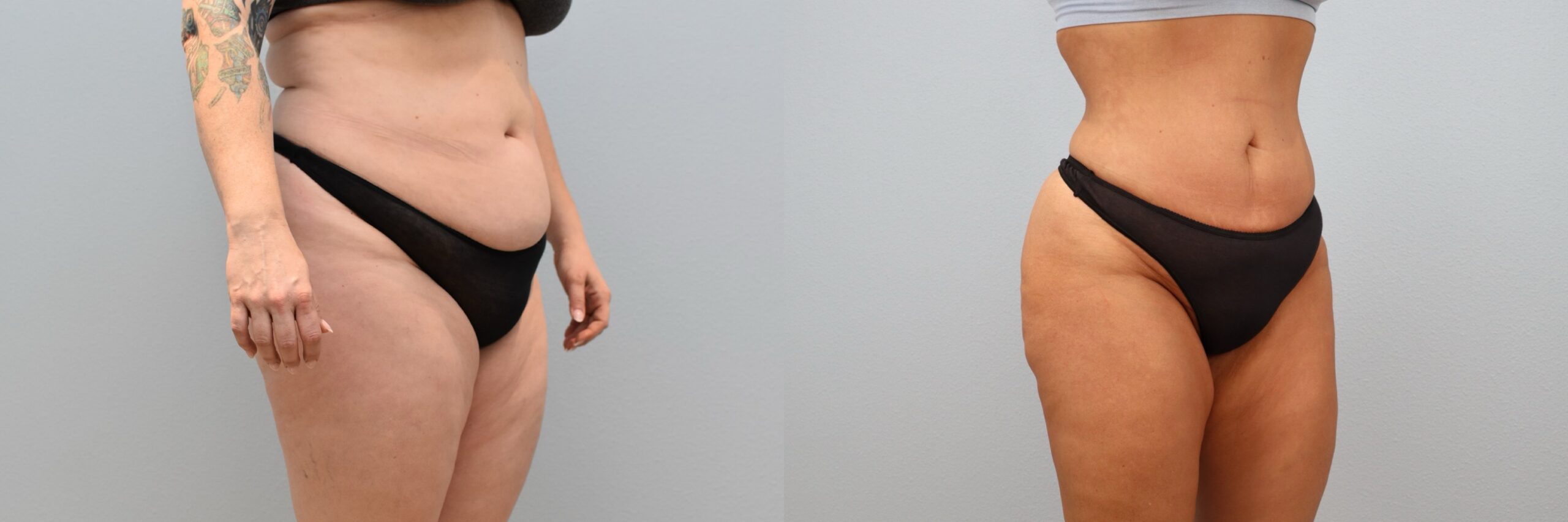 KD Lipo, BBL Left Angle