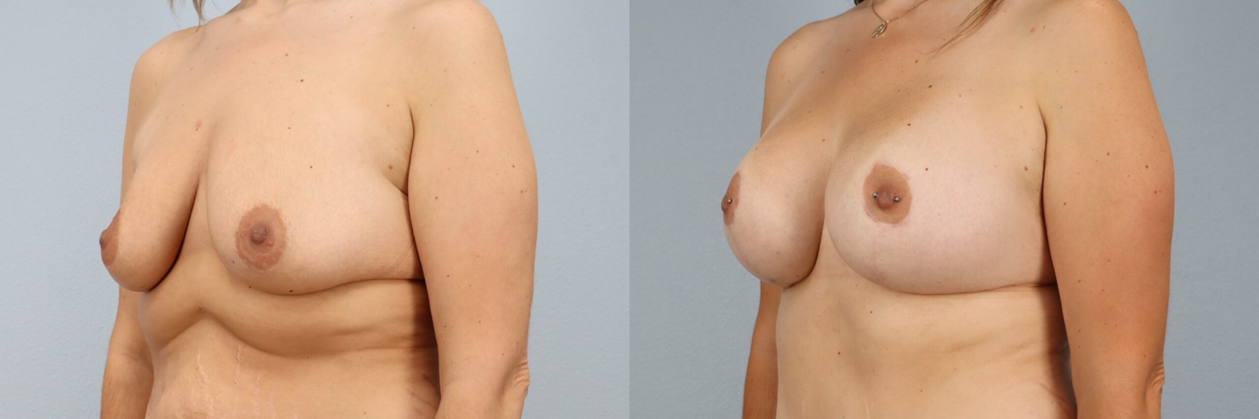 Before and after – Breast Lift With Implants – Female patient, age 30-39 – Image 5