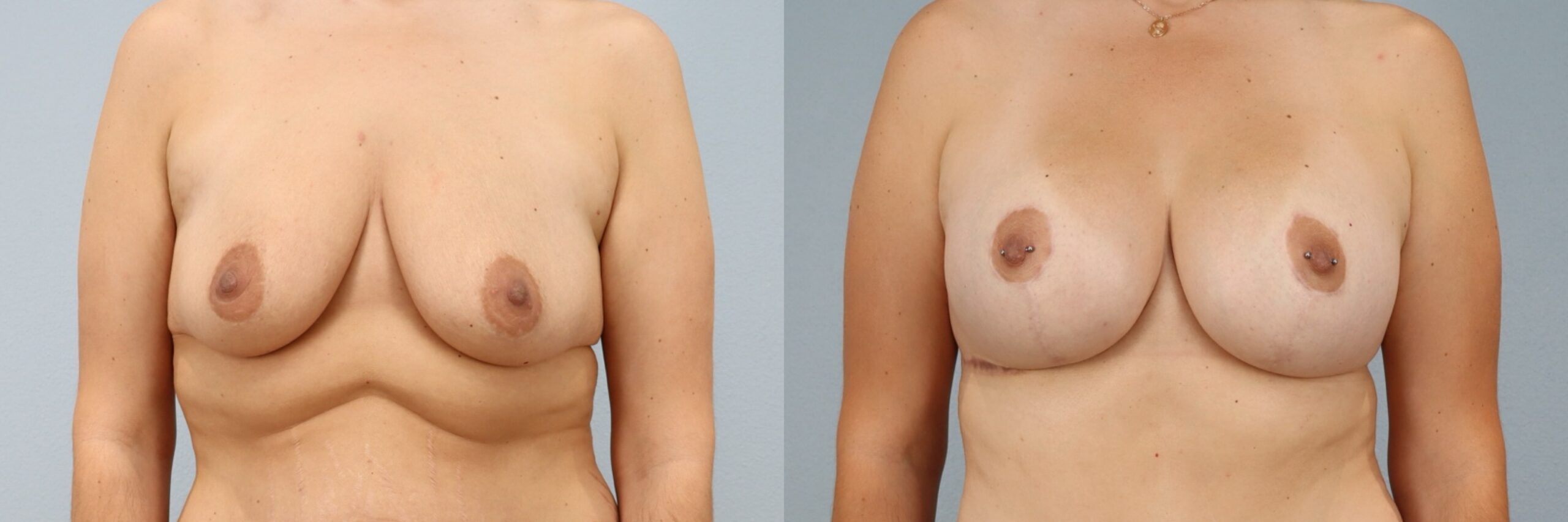 Before and after – Breast Lift With Implants – Female patient, age 30-39 – Image 4