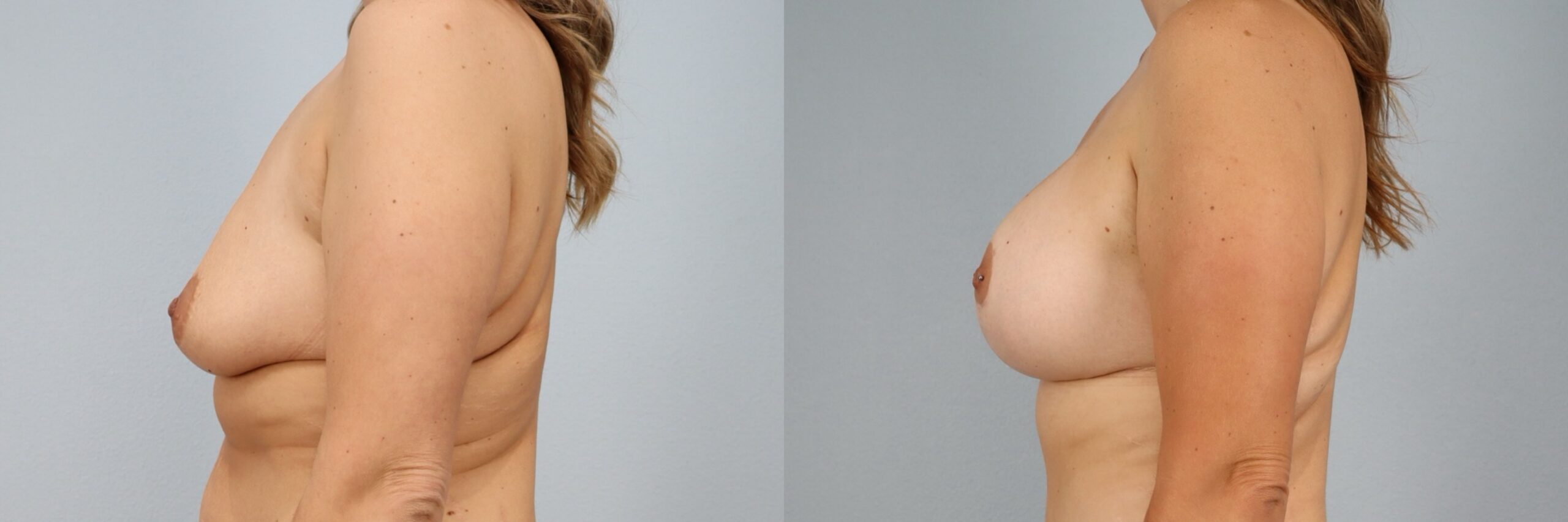 Before and after – Breast Lift With Implants – Female patient, age 30-39 – Image 6