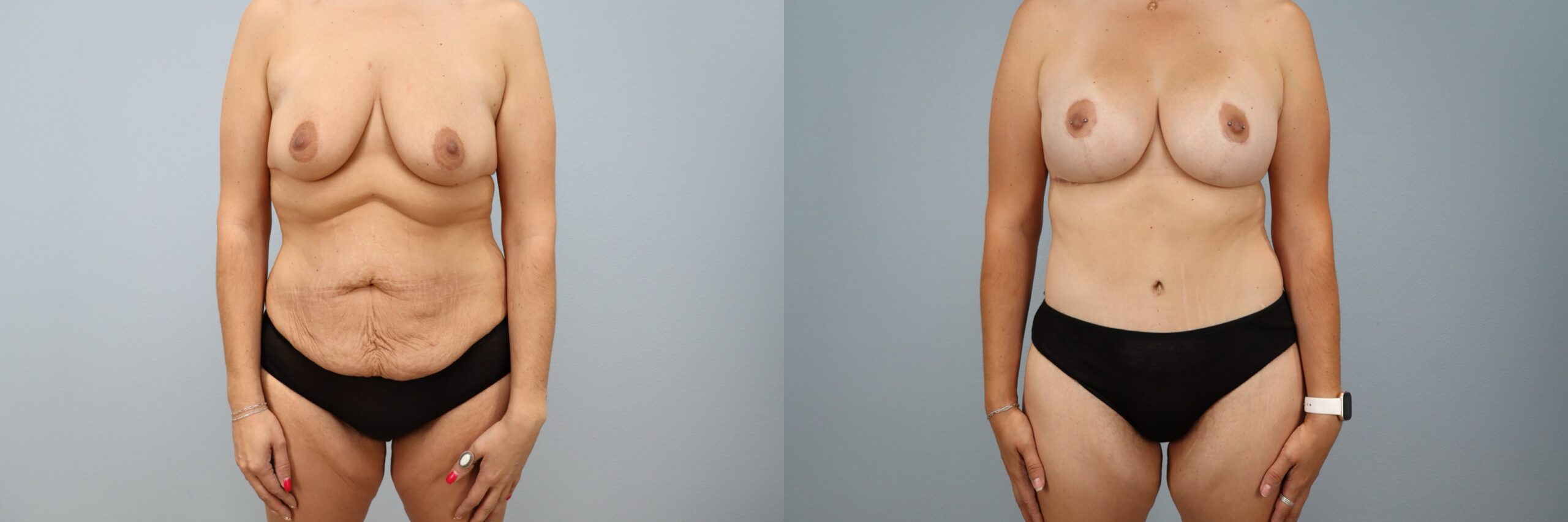 Before and after – Mommy Makeover – Female patient, age 30-39 – Image 52