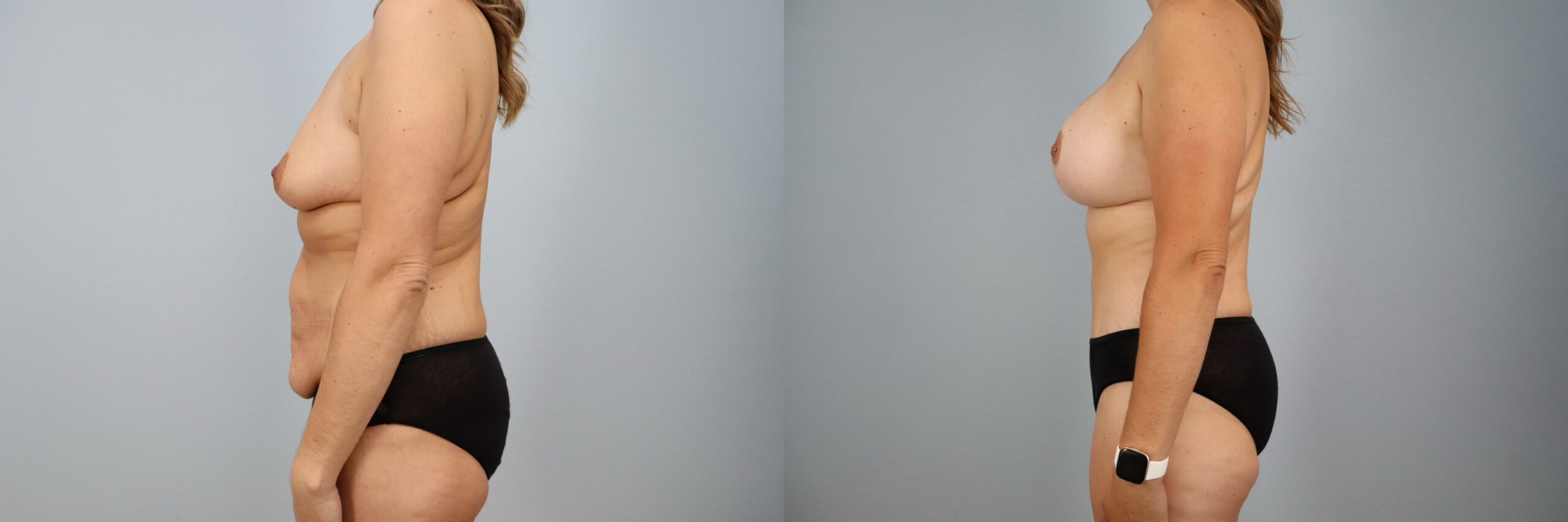 Before and after – Mommy Makeover – Female patient, age 30-39 – Image 54