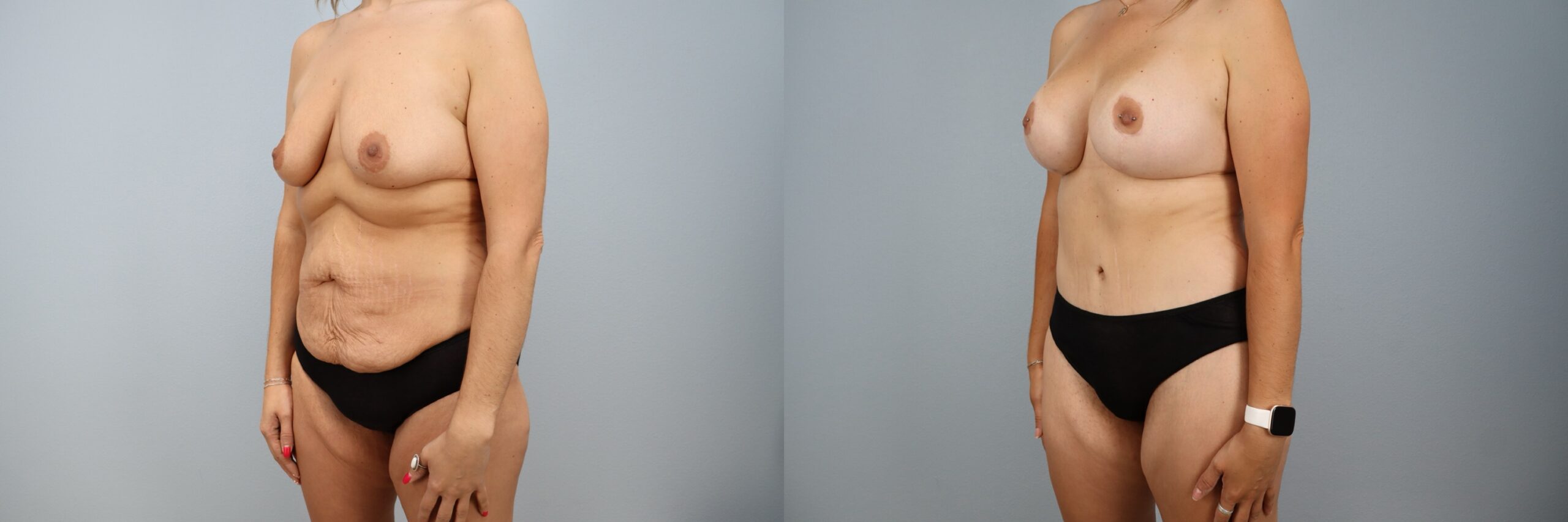 Before and after – Mommy Makeover – Female patient, age 30-39 – Image 53