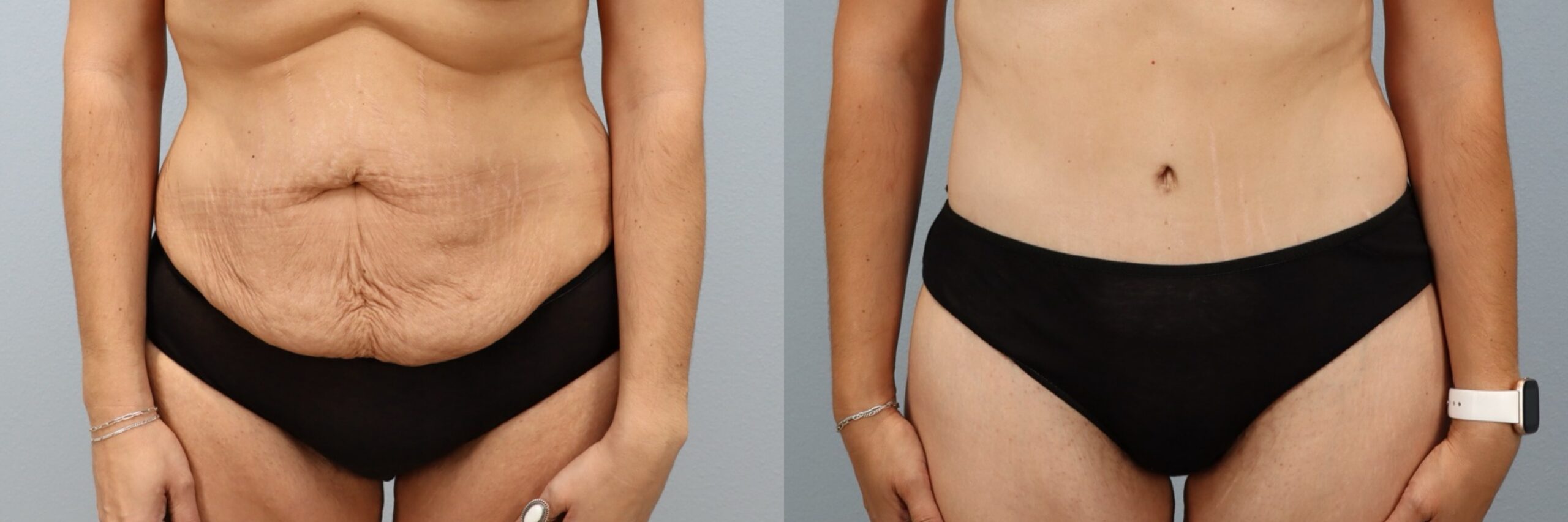 Before and after – Tummy Tuck – Female patient, age 30-39 – Image 16