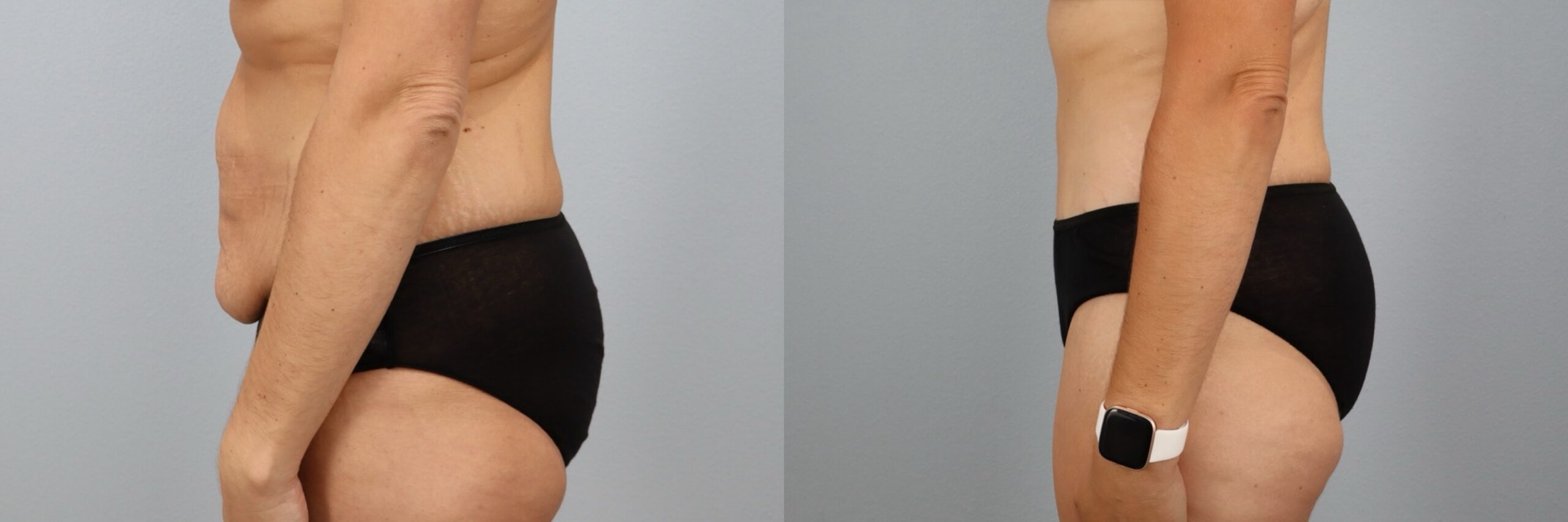 Before and after – Tummy Tuck – Female patient, age 30-39 – Image 18