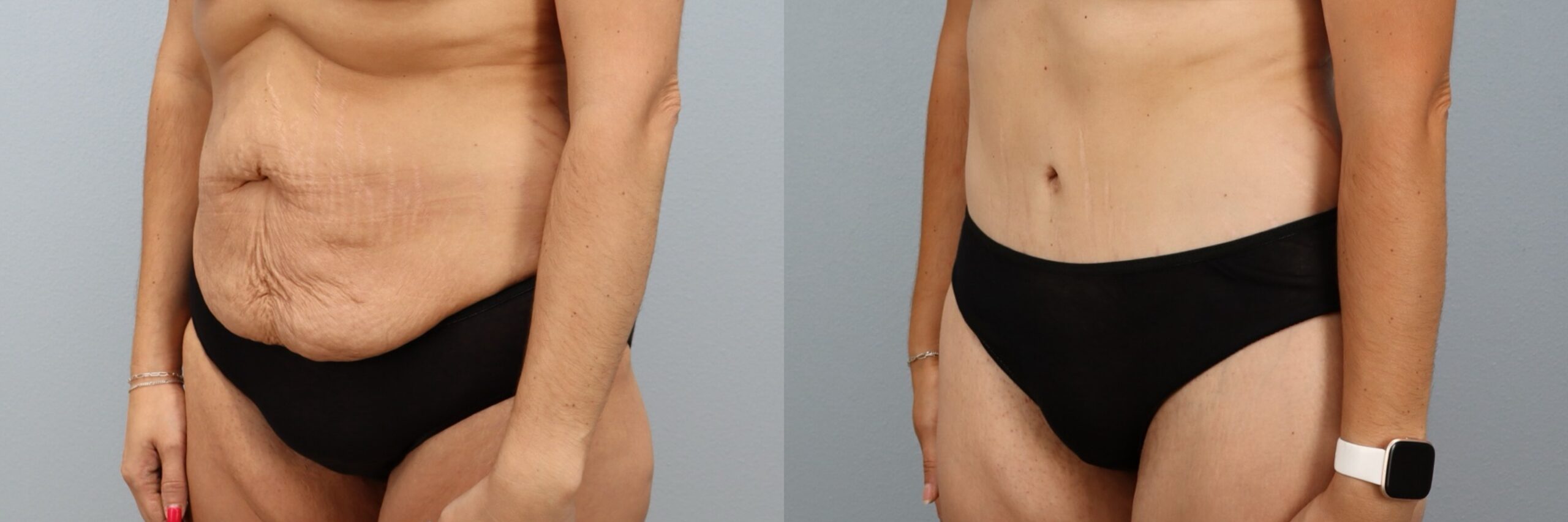 Before and after – Tummy Tuck – Female patient, age 30-39 – Image 17