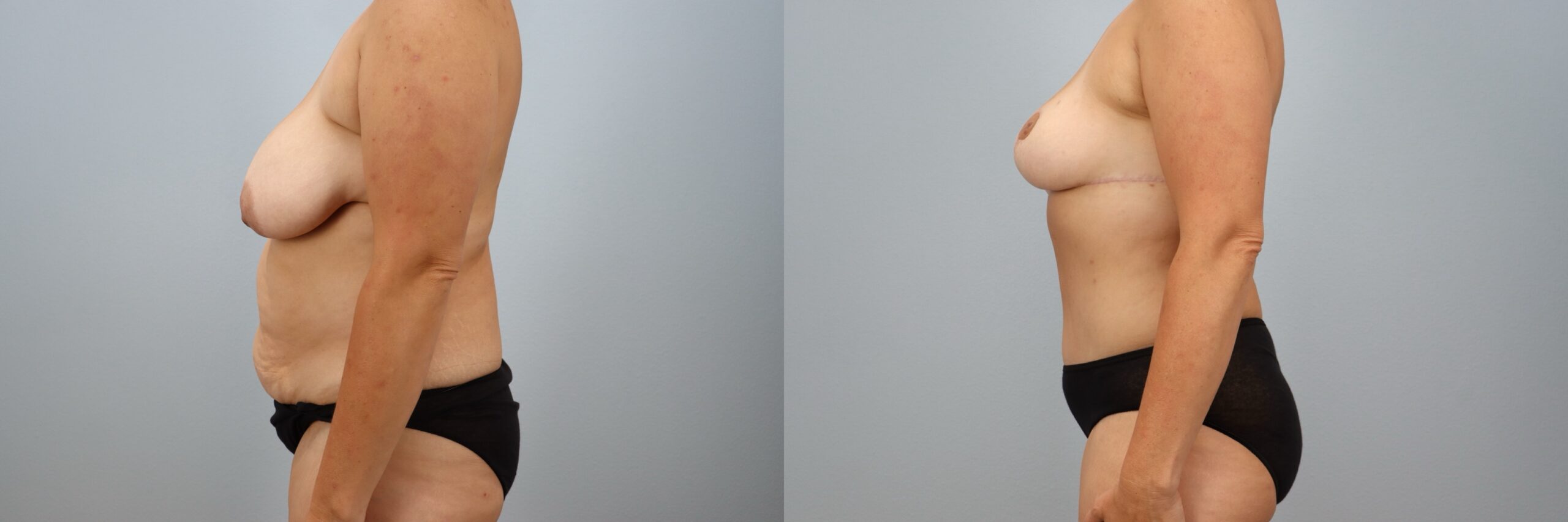 Before and after – Mommy Makeover – Female patient, age 40-49 – Image 27