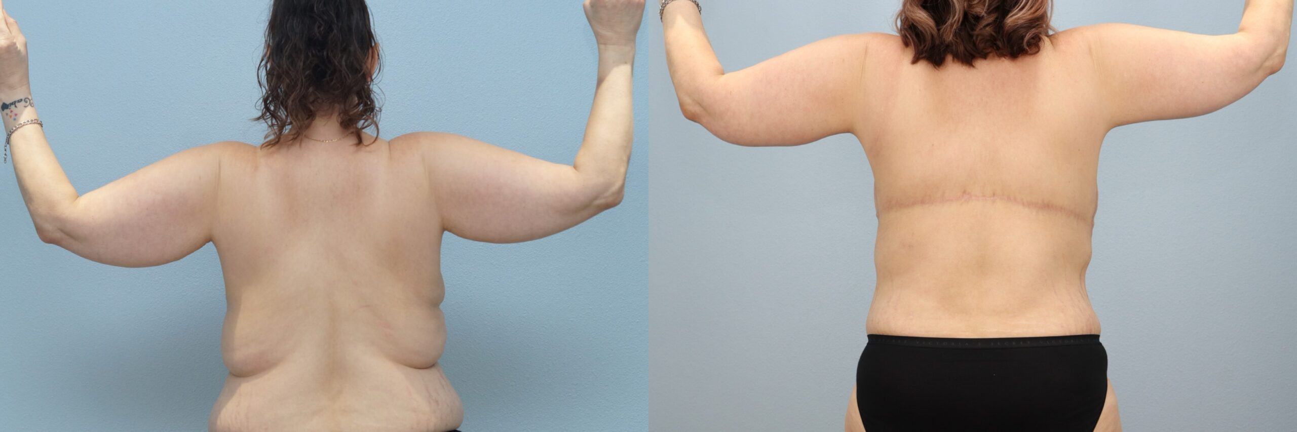 Before and after – Arm Lift – Female patient, age 40-49 – Image 29