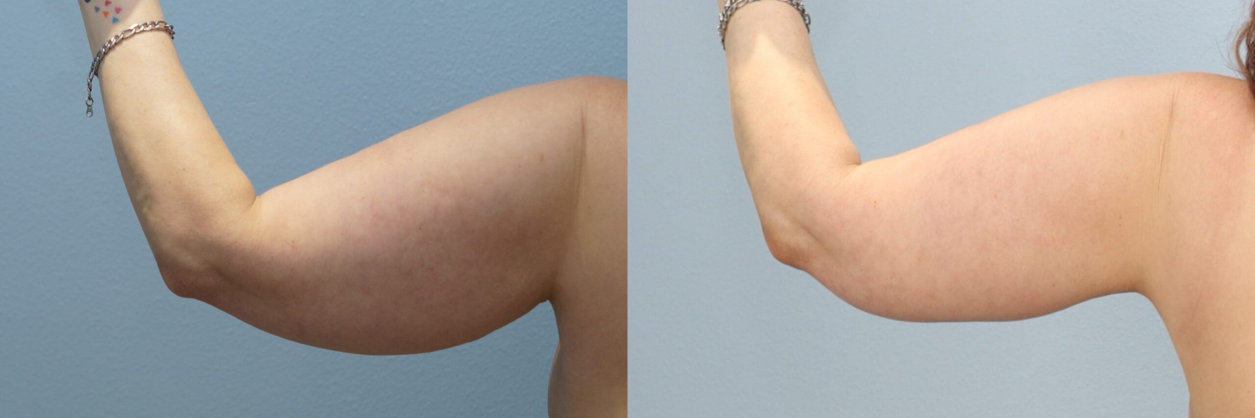 Before and after – Arm Lift – Female patient, age 40-49 – Image 28