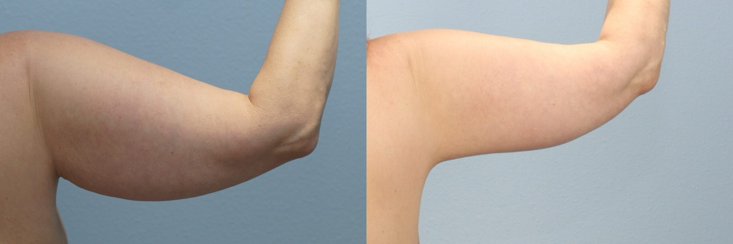 Before and after – Arm Lift – Female patient, age 40-49 – Image 30