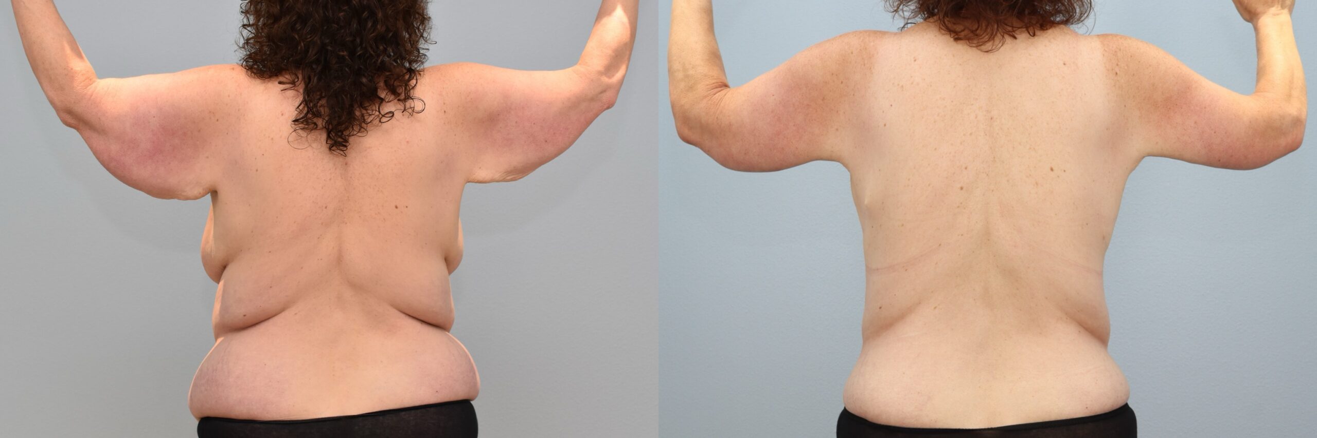 Before and after – Arm Lift – Female patient, age 60+ – Image 20