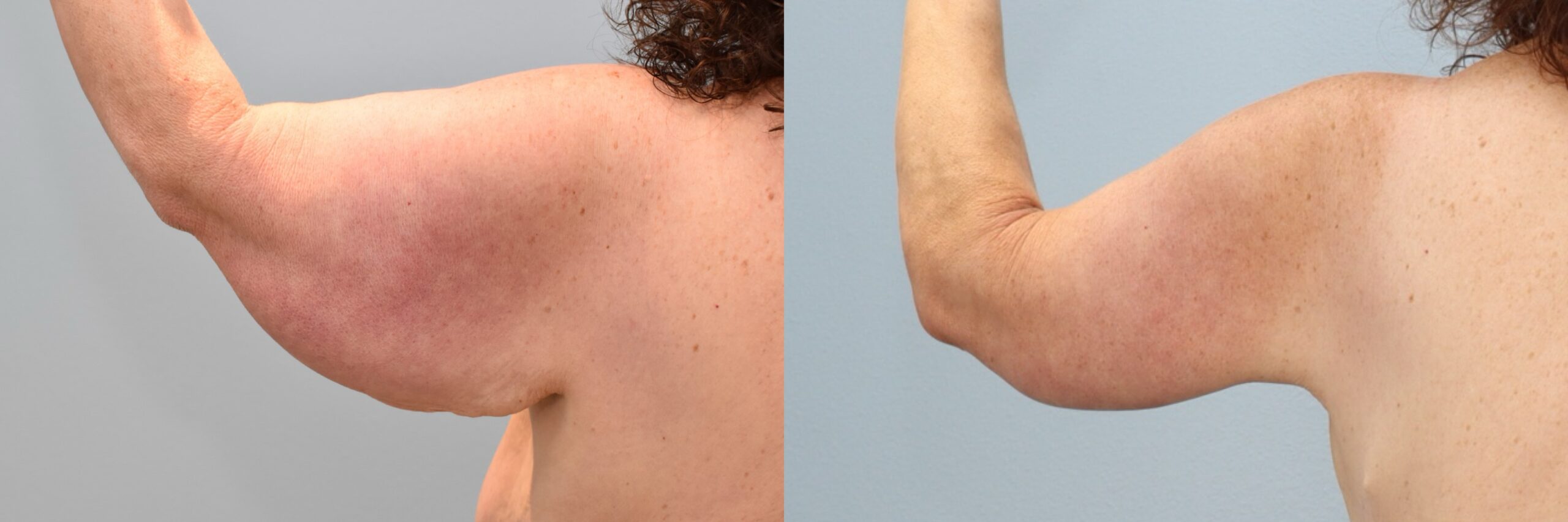 Before and after – Arm Lift – Female patient, age 60+ – Image 19