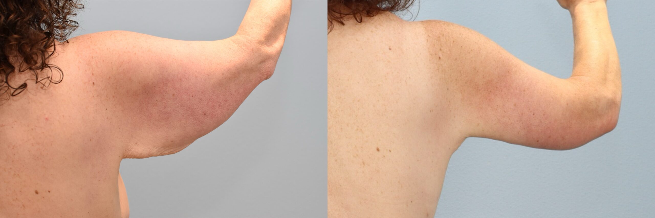 Before and after – Arm Lift – Female patient, age 60+ – Image 21