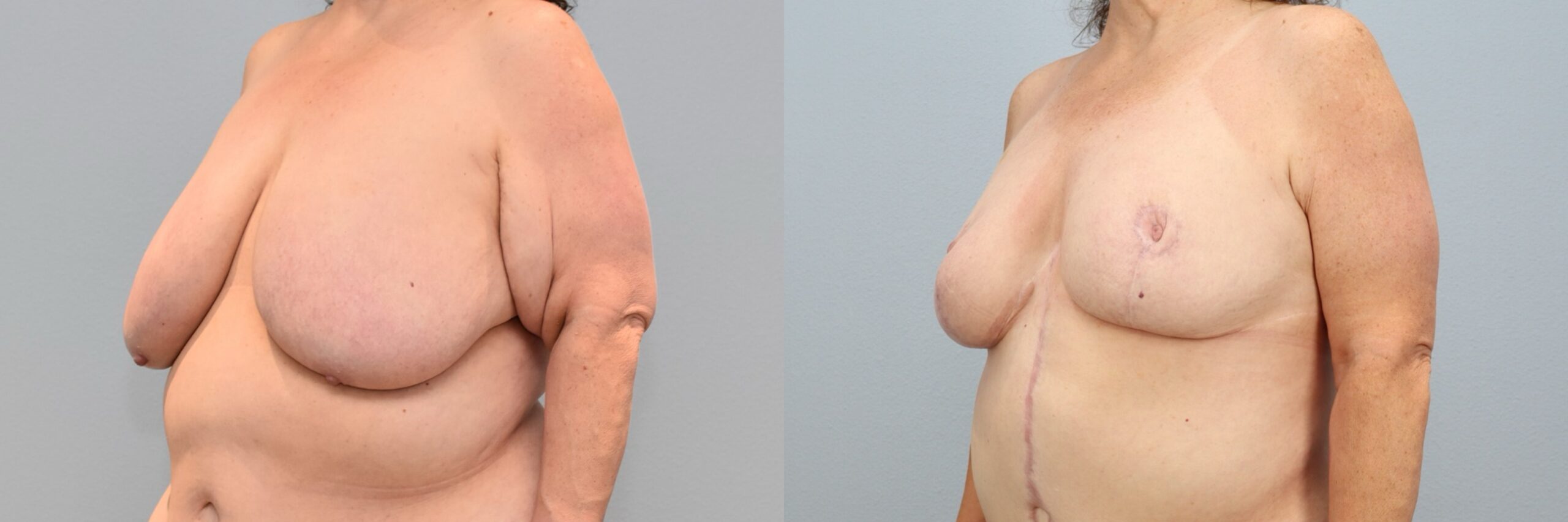Before and after – Breast Reduction – Female patient, age 60+ – Image 11