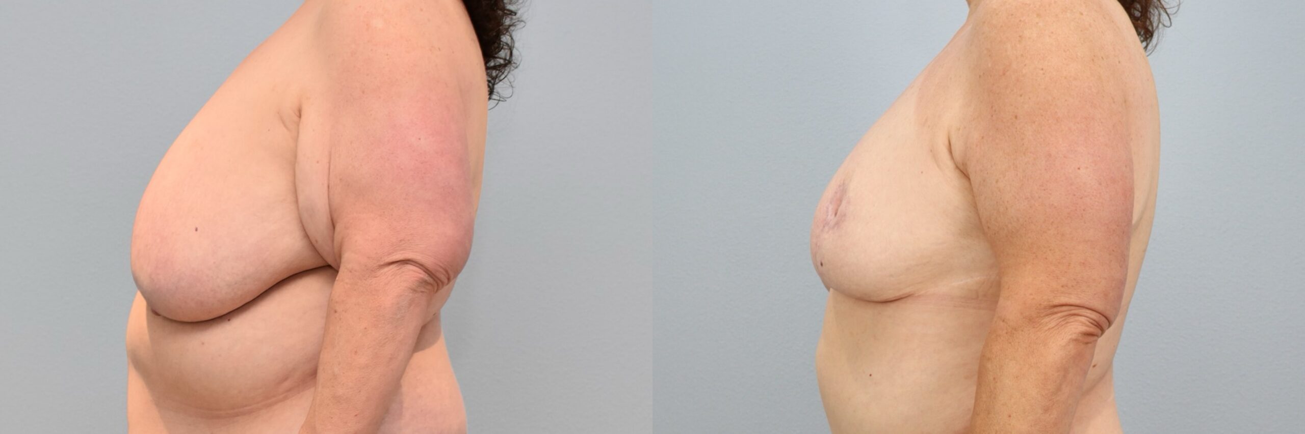 Before and after – Breast Reduction – Female patient, age 60+ – Image 12
