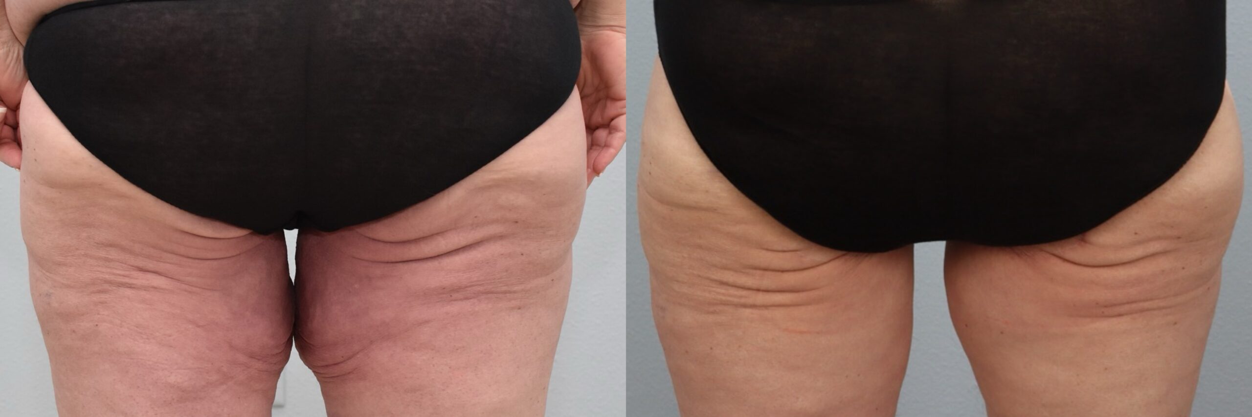 Before and after – Thigh Lift – Female patient, age 60+ – Image 27