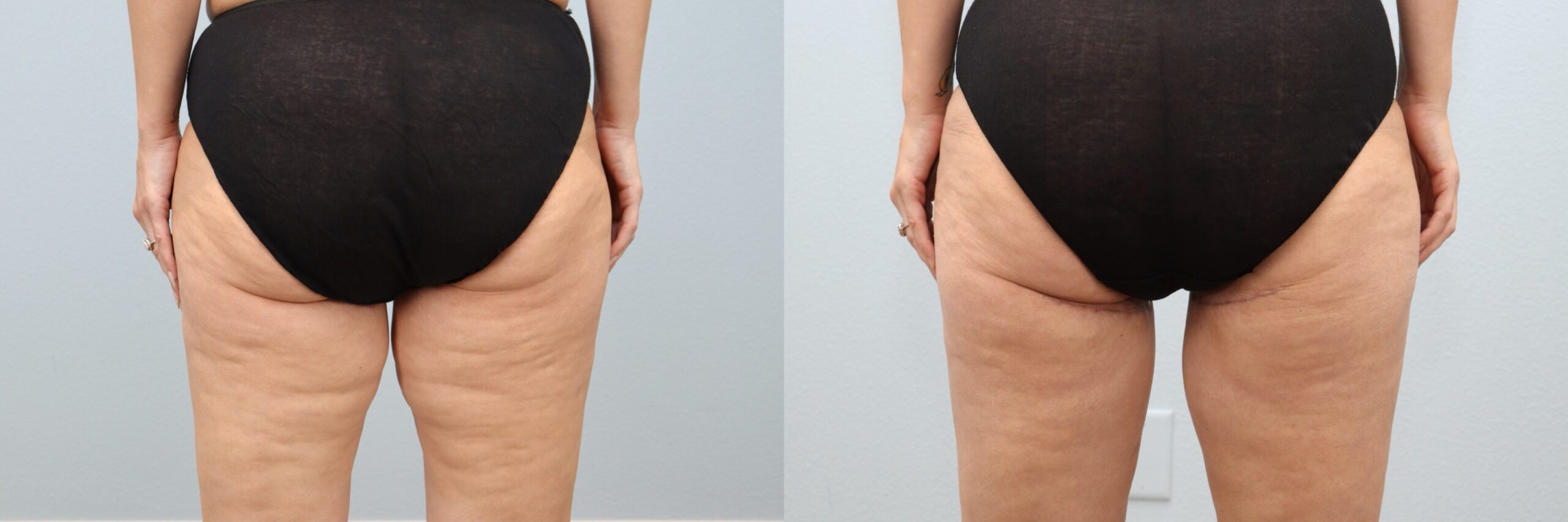 Before and after – Thigh Lift – Female patient, age 30-39 – Image 18