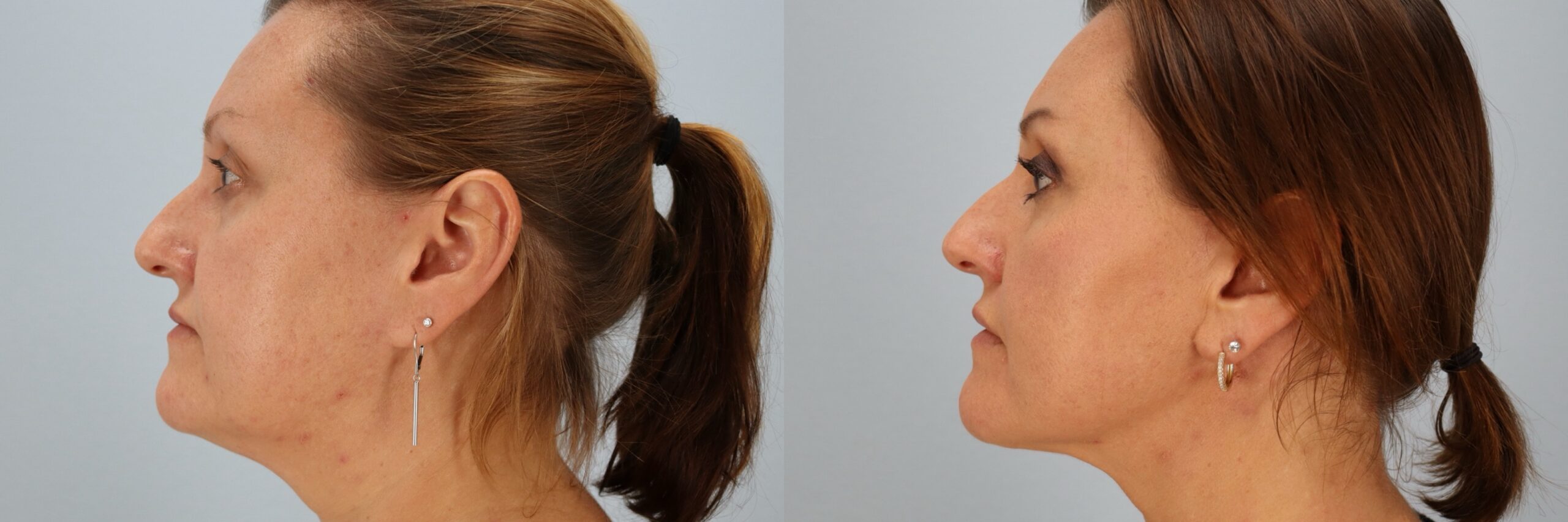 Before and after – Facelift Surgery – Female patient, age 40-49 – Image 12