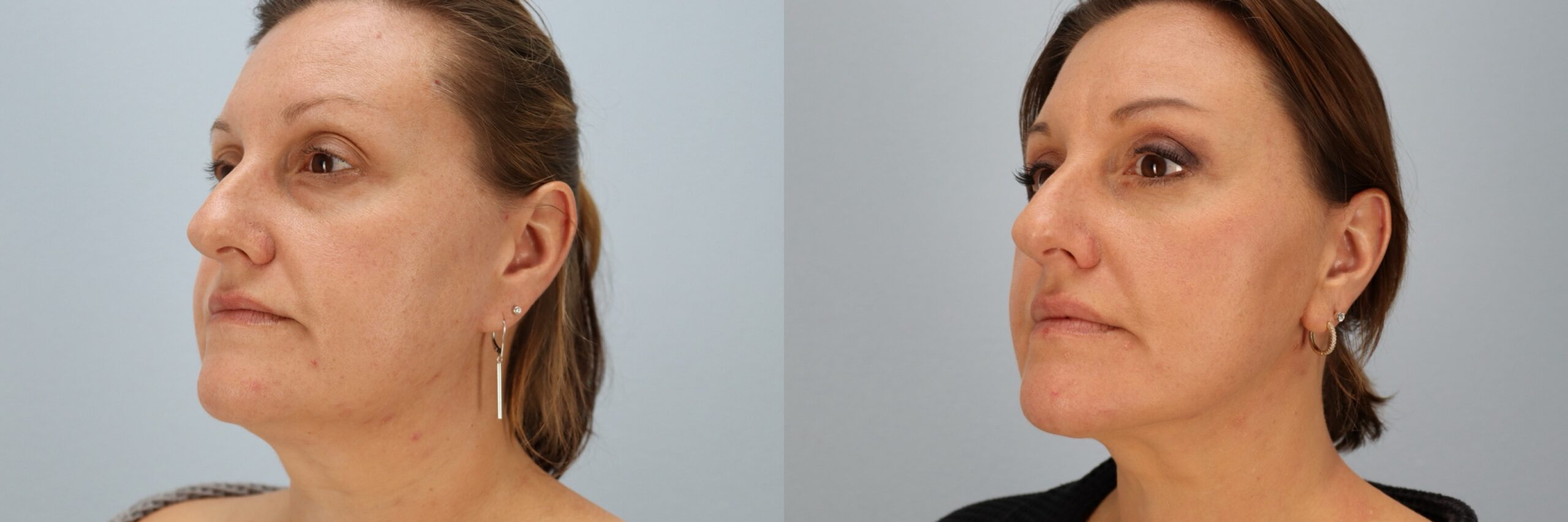 Before and after – Facelift Surgery – Female patient, age 40-49 – Image 11