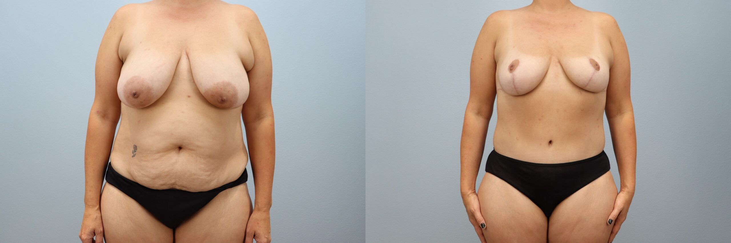 Before and after – Mommy Makeover – Female patient, age 40-49 – Image 25