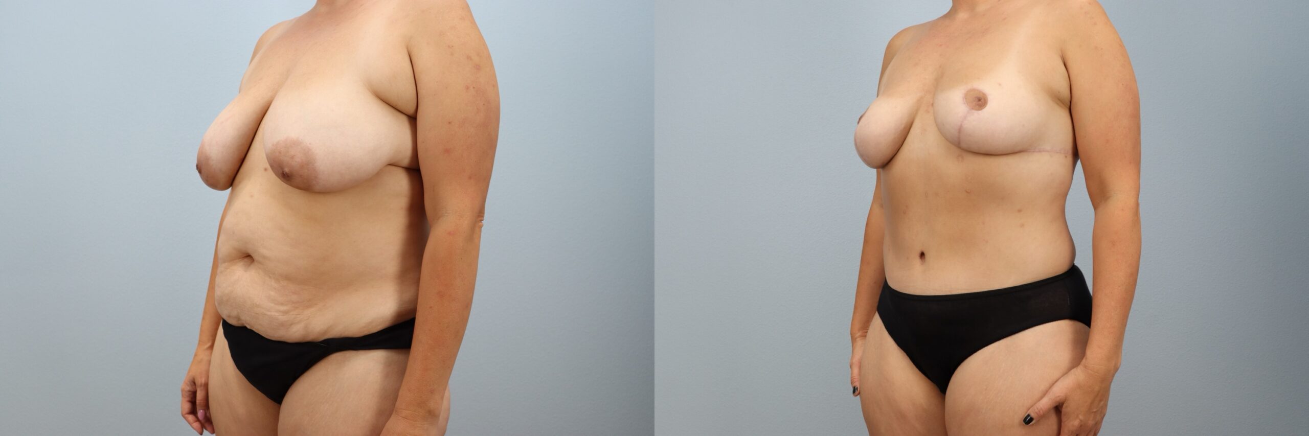 Before and after – Mommy Makeover – Female patient, age 40-49 – Image 26