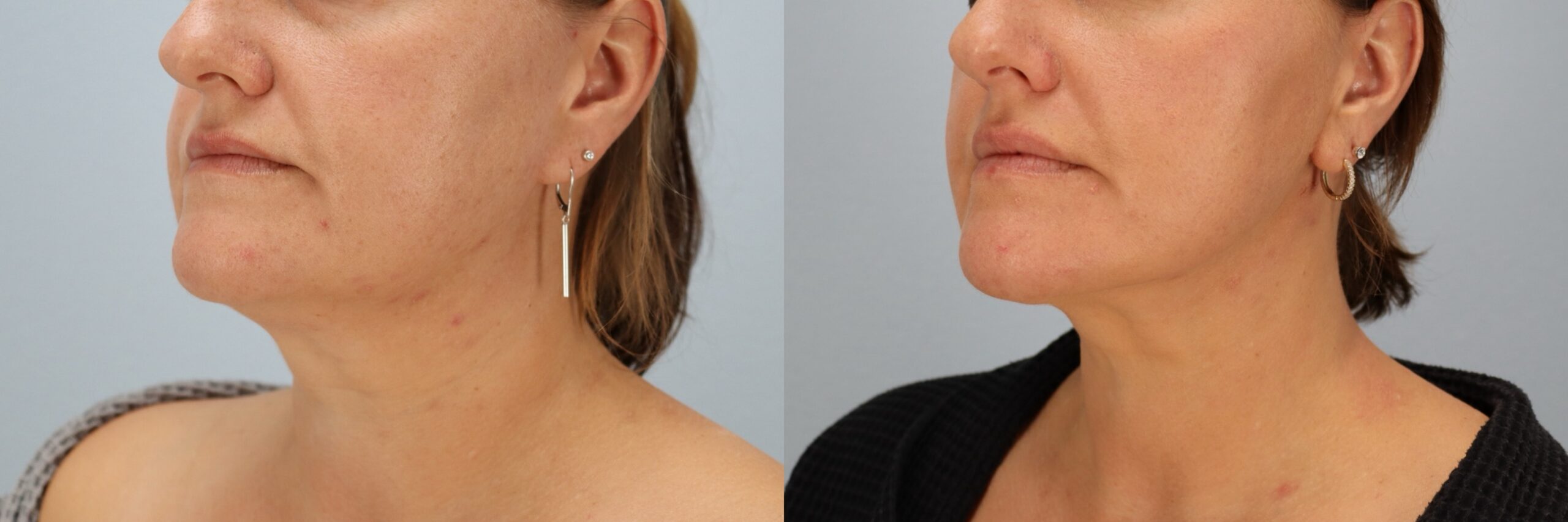 Before and after – Neck Lift – Female patient, age 40-49 – Image 23