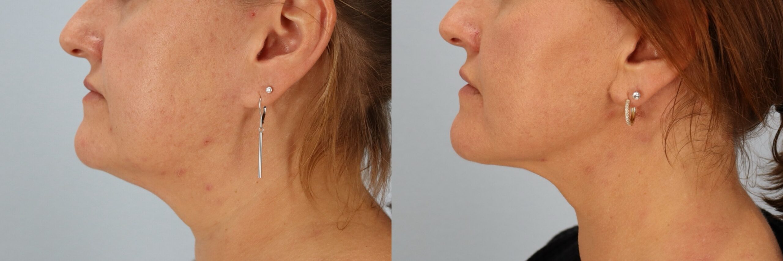 Before and after – Neck Lift – Female patient, age 40-49 – Image 24