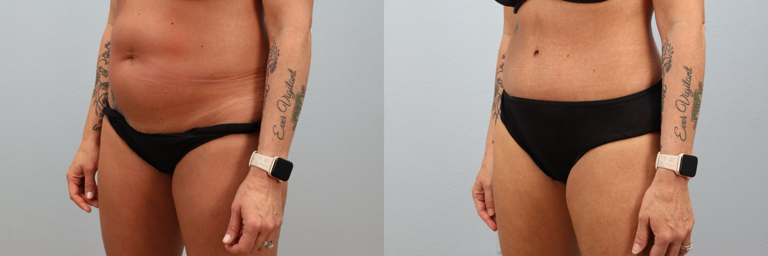 Before and after – Tummy Tuck – Female patient, age 40-49 – Image 8