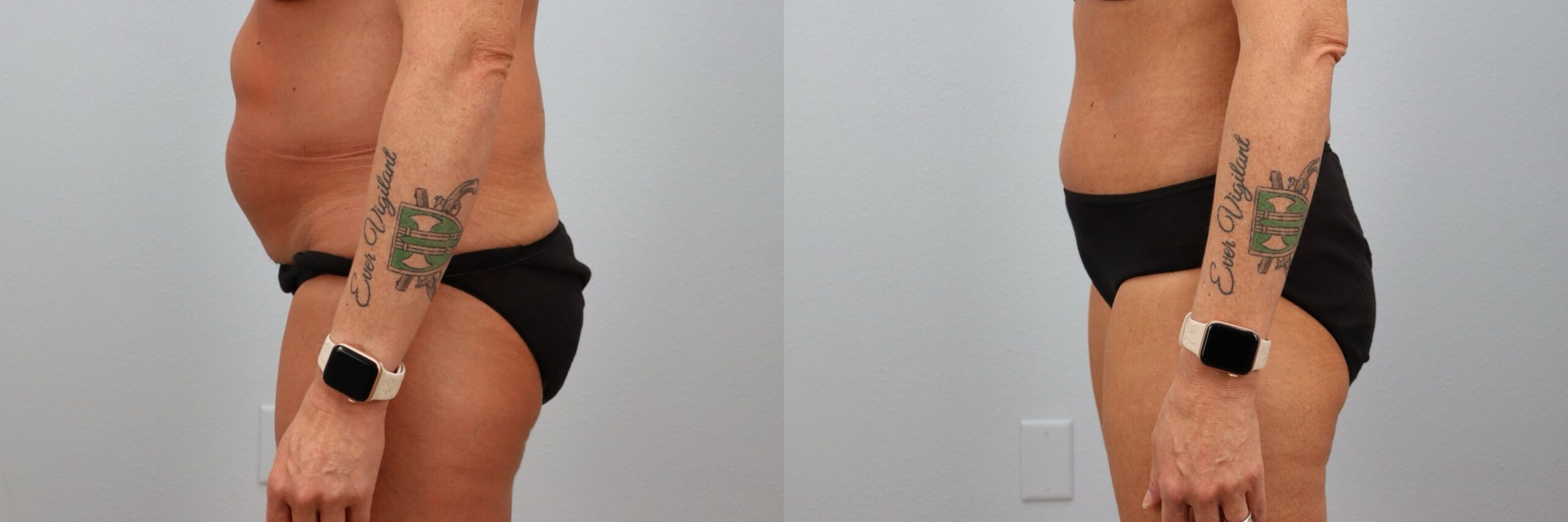 Before and after – Tummy Tuck – Female patient, age 40-49 – Image 9