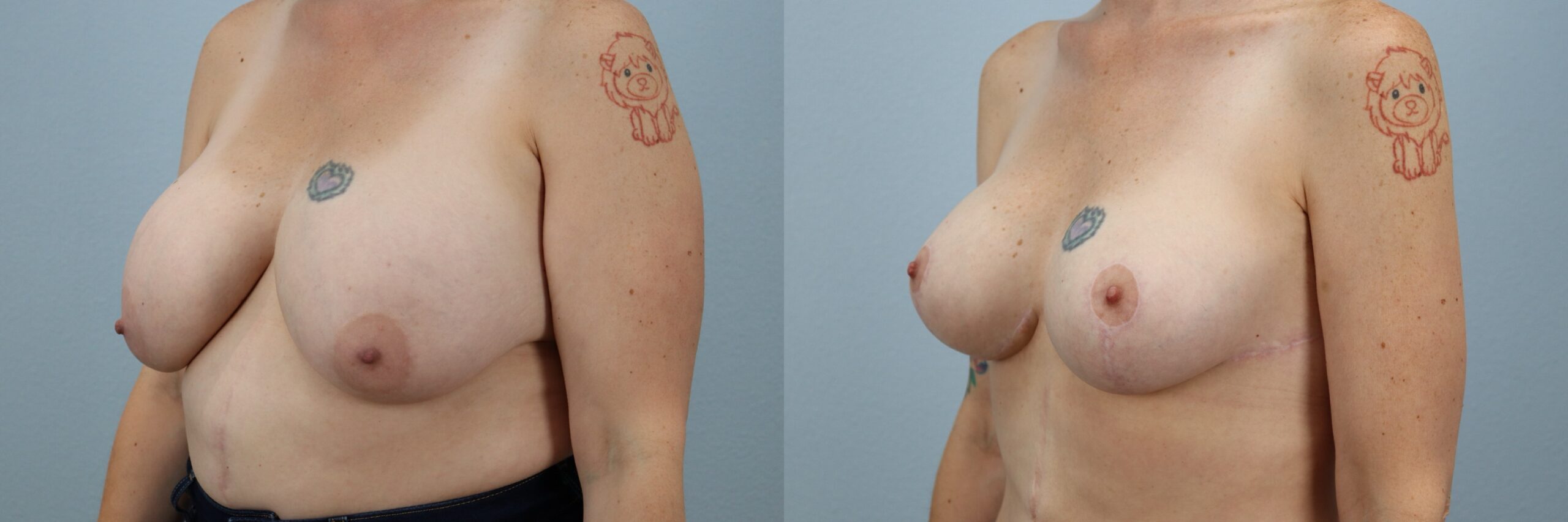 Before and after – Breast Revision – Female patient, age 40-49 – Image 29