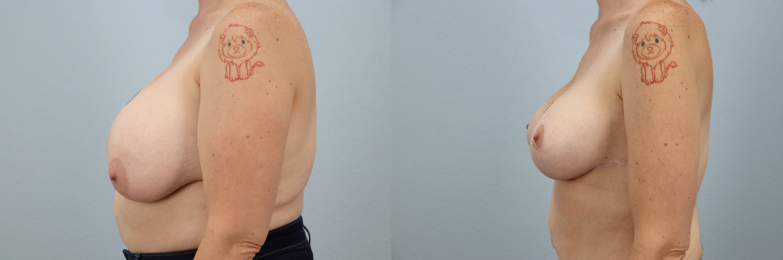 Before and after – Breast Revision – Female patient, age 40-49 – Image 30