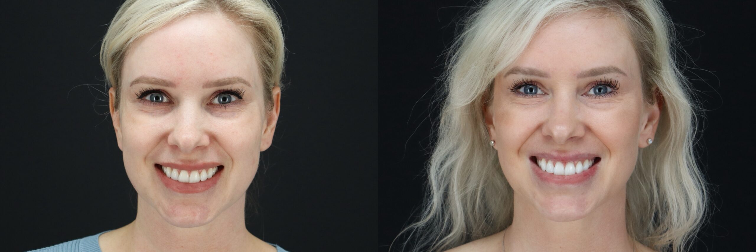 Before and after – Filler – Female patient, age 30-39 – Image 41