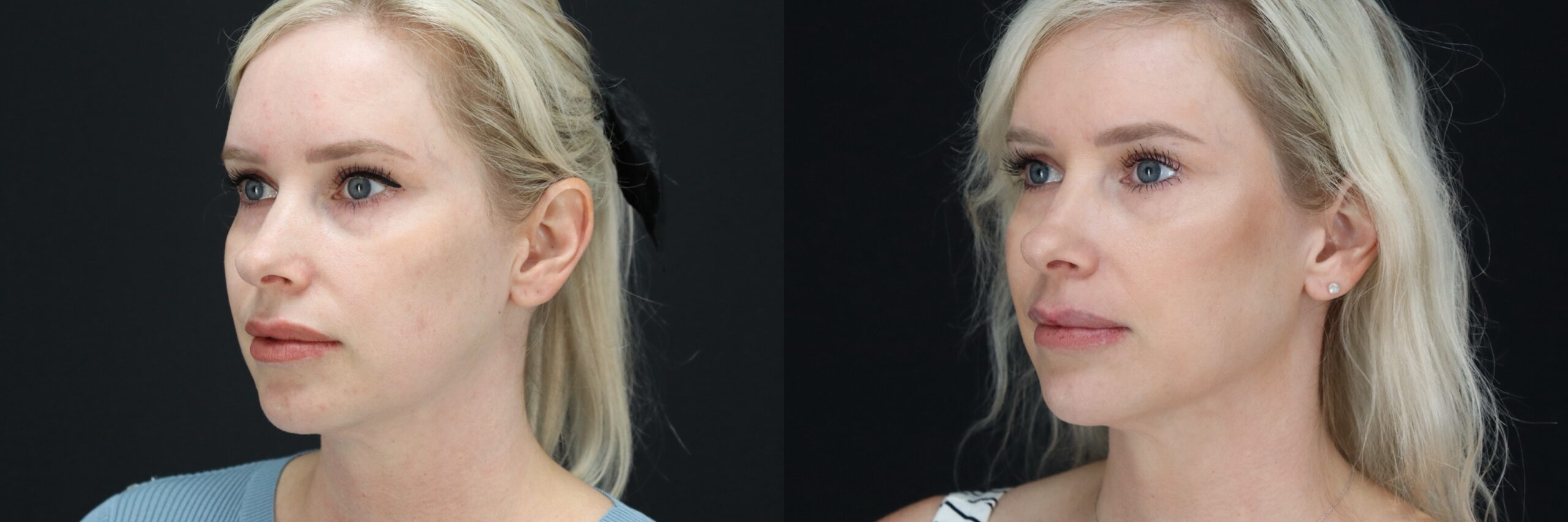 Before and after – Filler – Female patient, age 30-39 – Image 42