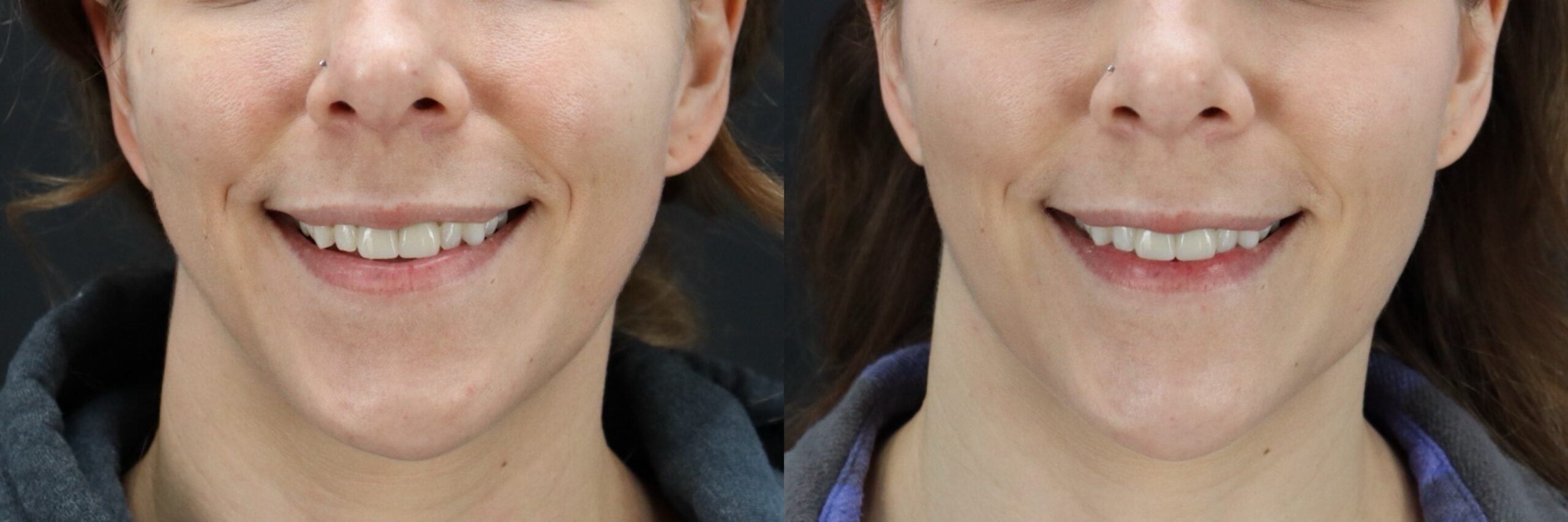 Before and after – Filler – Female patient, age 30-39 – Image 44